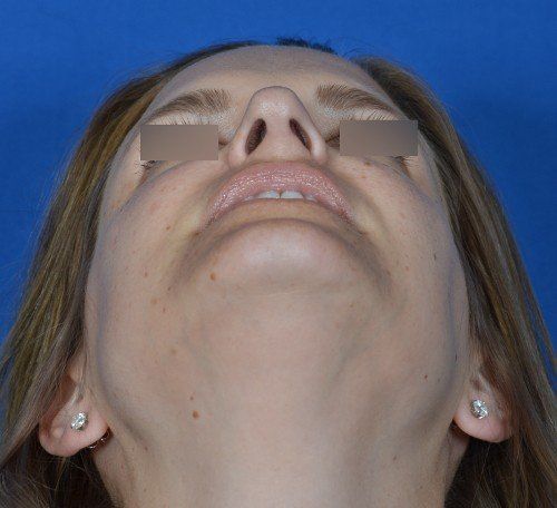 female revision rhinoplasty