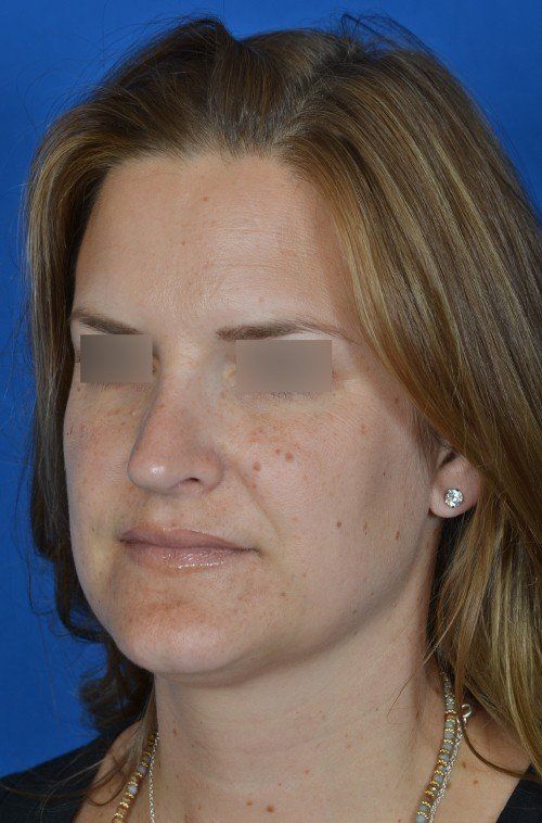 female revision rhinoplasty