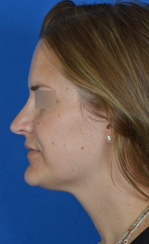 female revision rhinoplasty