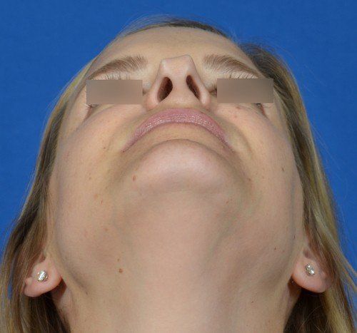 female revision rhinoplasty