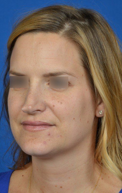 female revision rhinoplasty