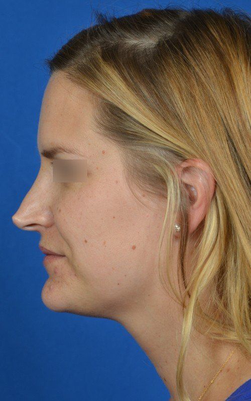 female revision rhinoplasty