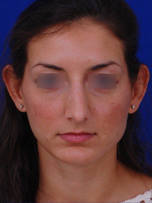rhinoplasty