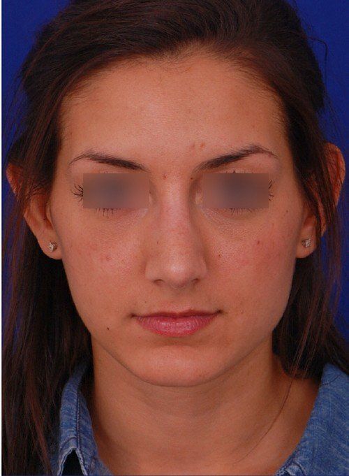 rhinoplasty