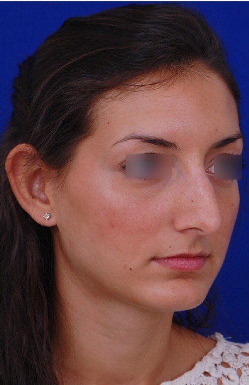 rhinoplasty