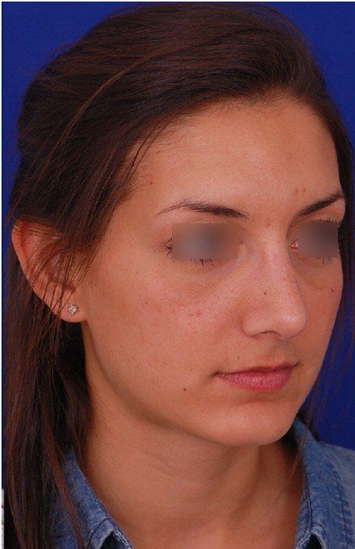 rhinoplasty