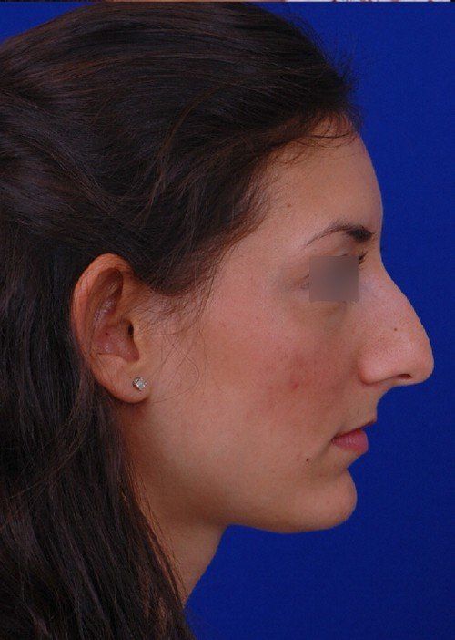 rhinoplasty