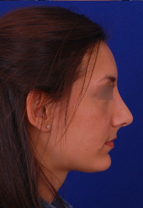 rhinoplasty