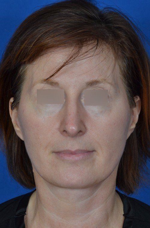mini facelift before and after