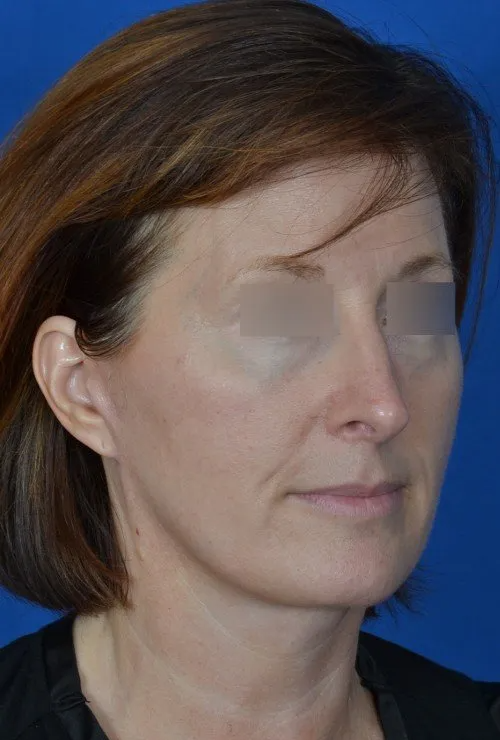 mini facelift before and after