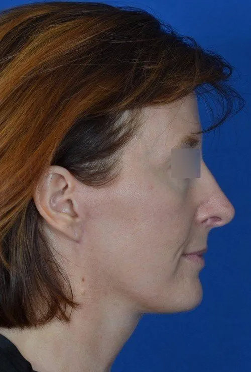 mini facelift before and after
