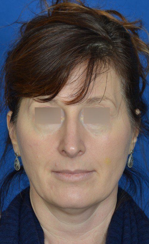 mini facelift before and after