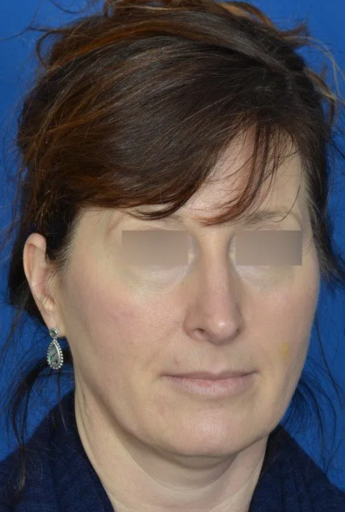 mini facelift before and after
