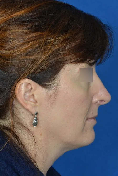 mini facelift before and after