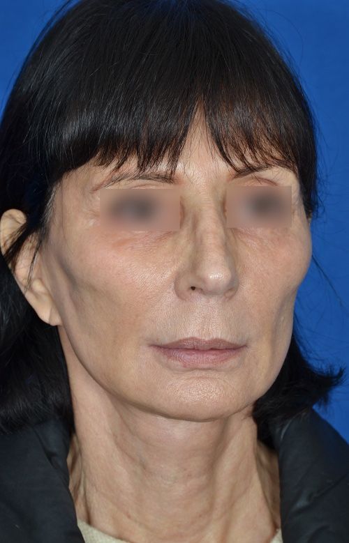 mini facelift before and after