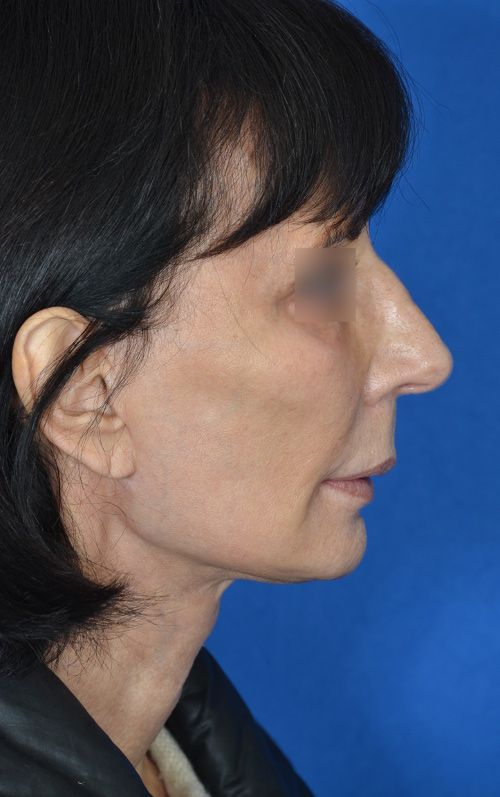 mini-facelift-before-after-lower-face-tightening.jpg