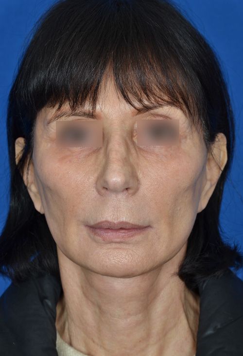 mini facelift before and after