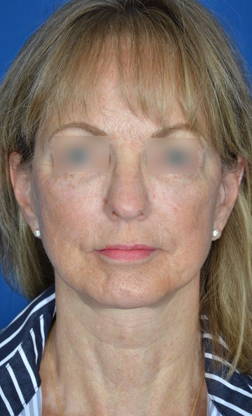 mini facelift before and after