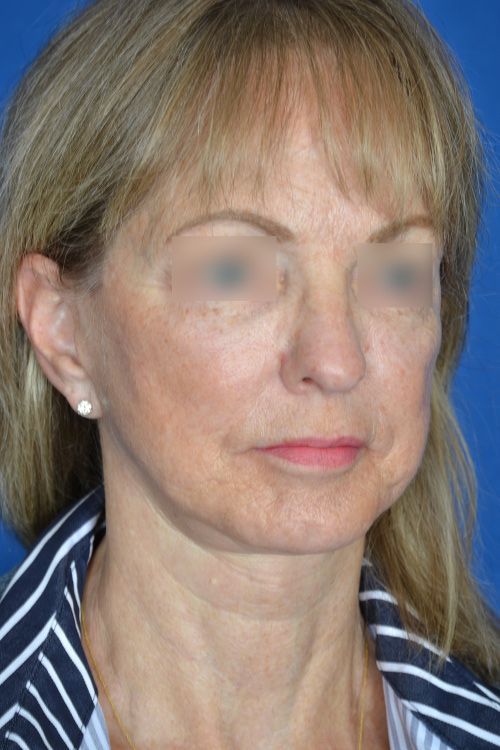 mini facelift before and after