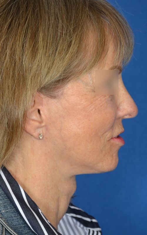 mini facelift before and after