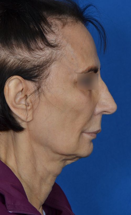 mini-facelift-before-after-lower-face-tightening.jpg