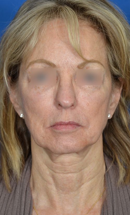 mini facelift before and after