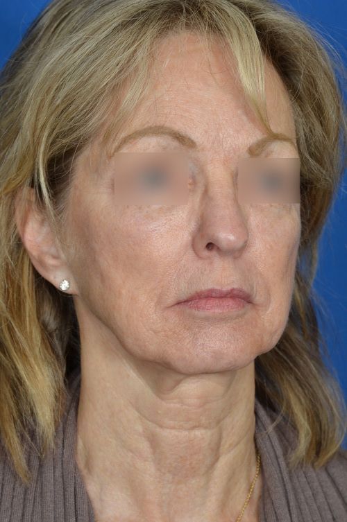 mini facelift before and after