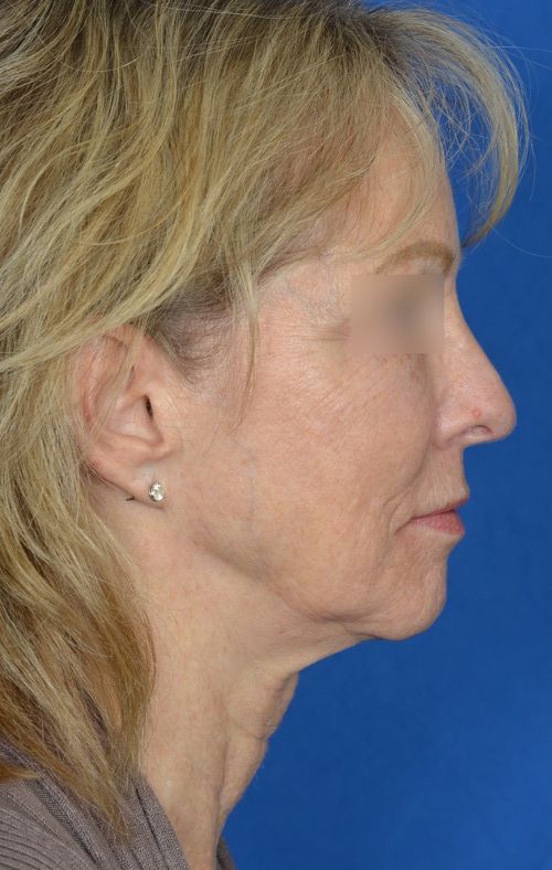 mini facelift before and after