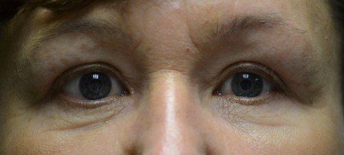 blepharoplasty before and after