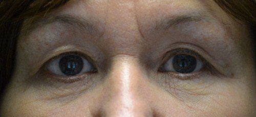 blepharoplasty before and after