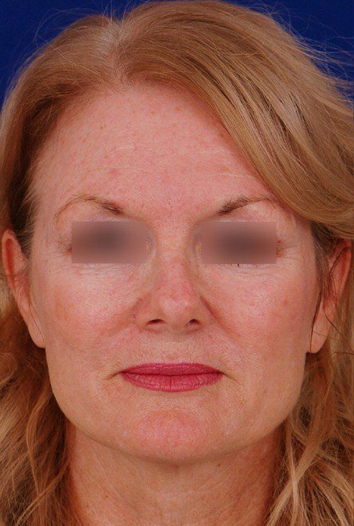 rhinoplasty