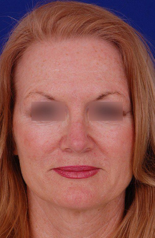 rhinoplasty