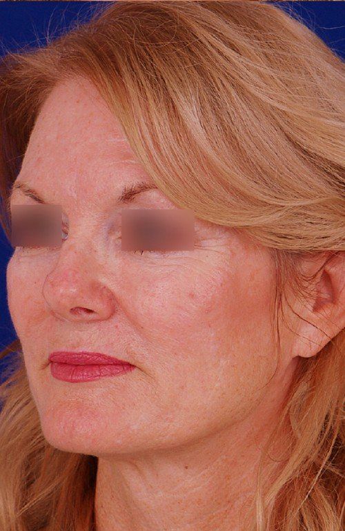 rhinoplasty