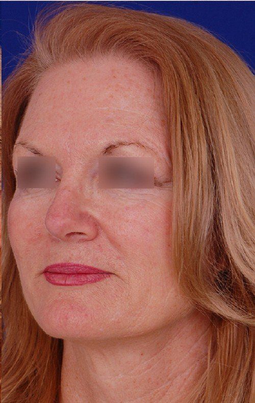 rhinoplasty
