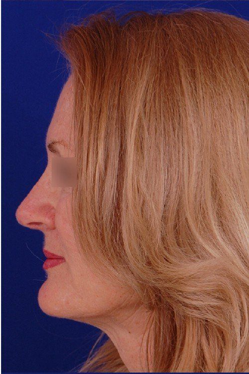 rhinoplasty