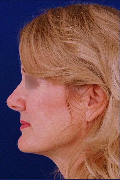 rhinoplasty