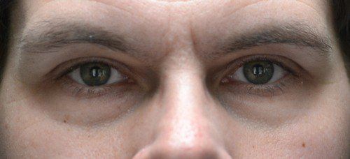 blepharoplasty before and after