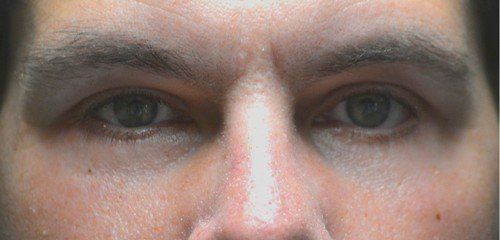 blepharoplasty before and after