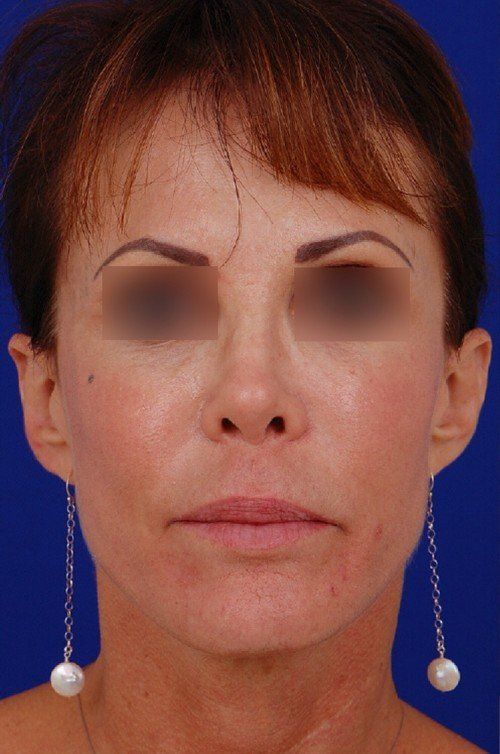female revision rhinoplasty