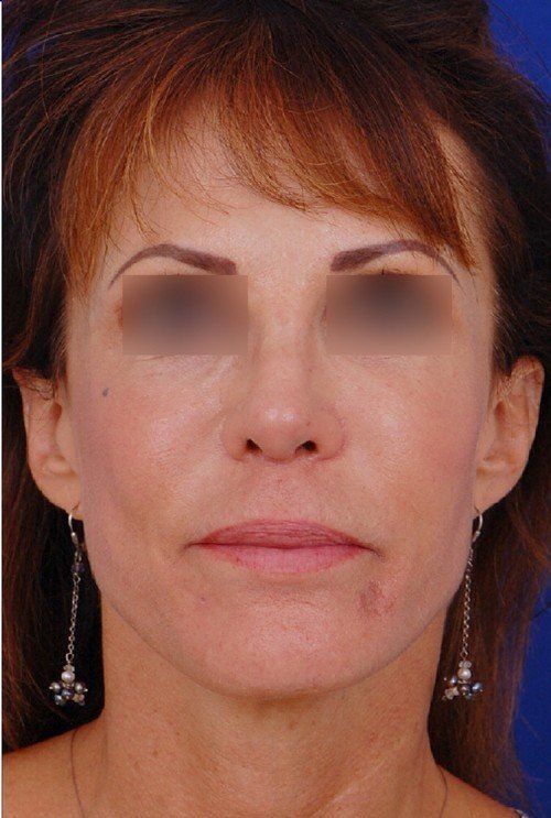 female revision rhinoplasty