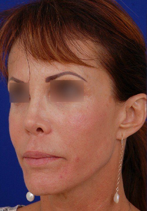 female revision rhinoplasty
