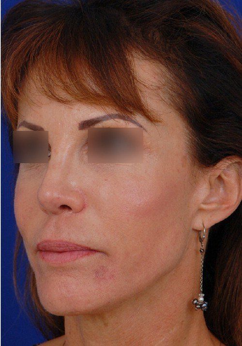 female revision rhinoplasty