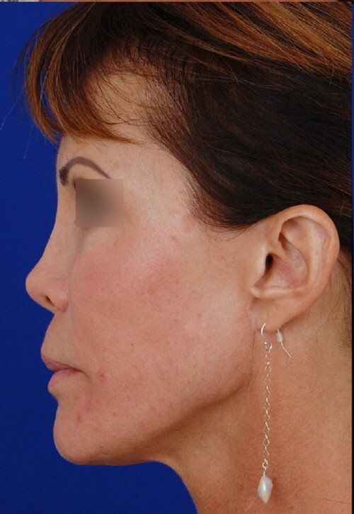 female revision rhinoplasty