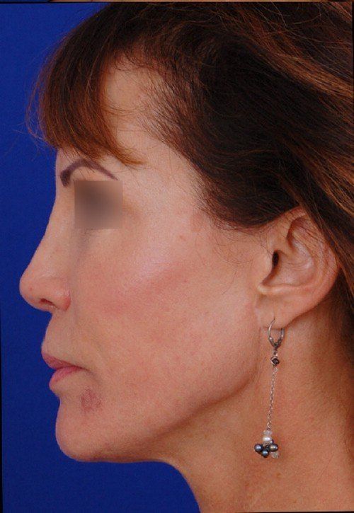 female revision rhinoplasty