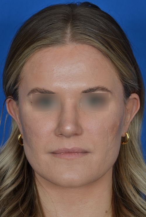 female rhinoplasty