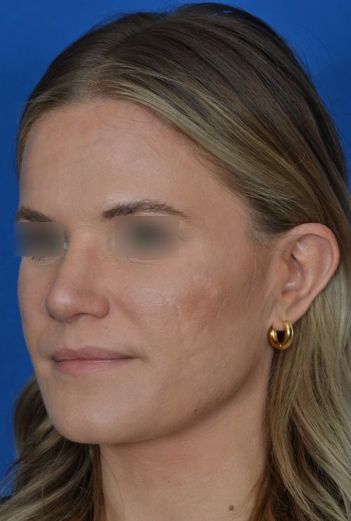 female rhinoplasty