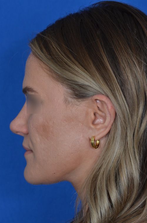 female rhinoplasty