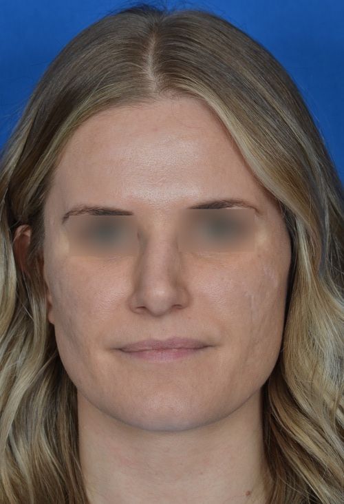 before rhinoplasty