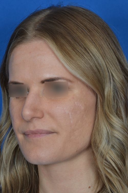 before rhinoplasty