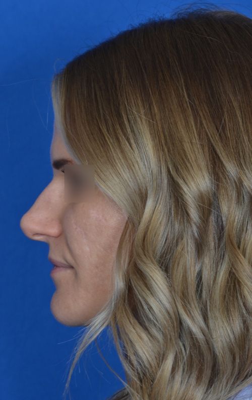 before rhinoplasty